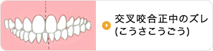 交叉咬合(こうさこうごう)正中のズレ